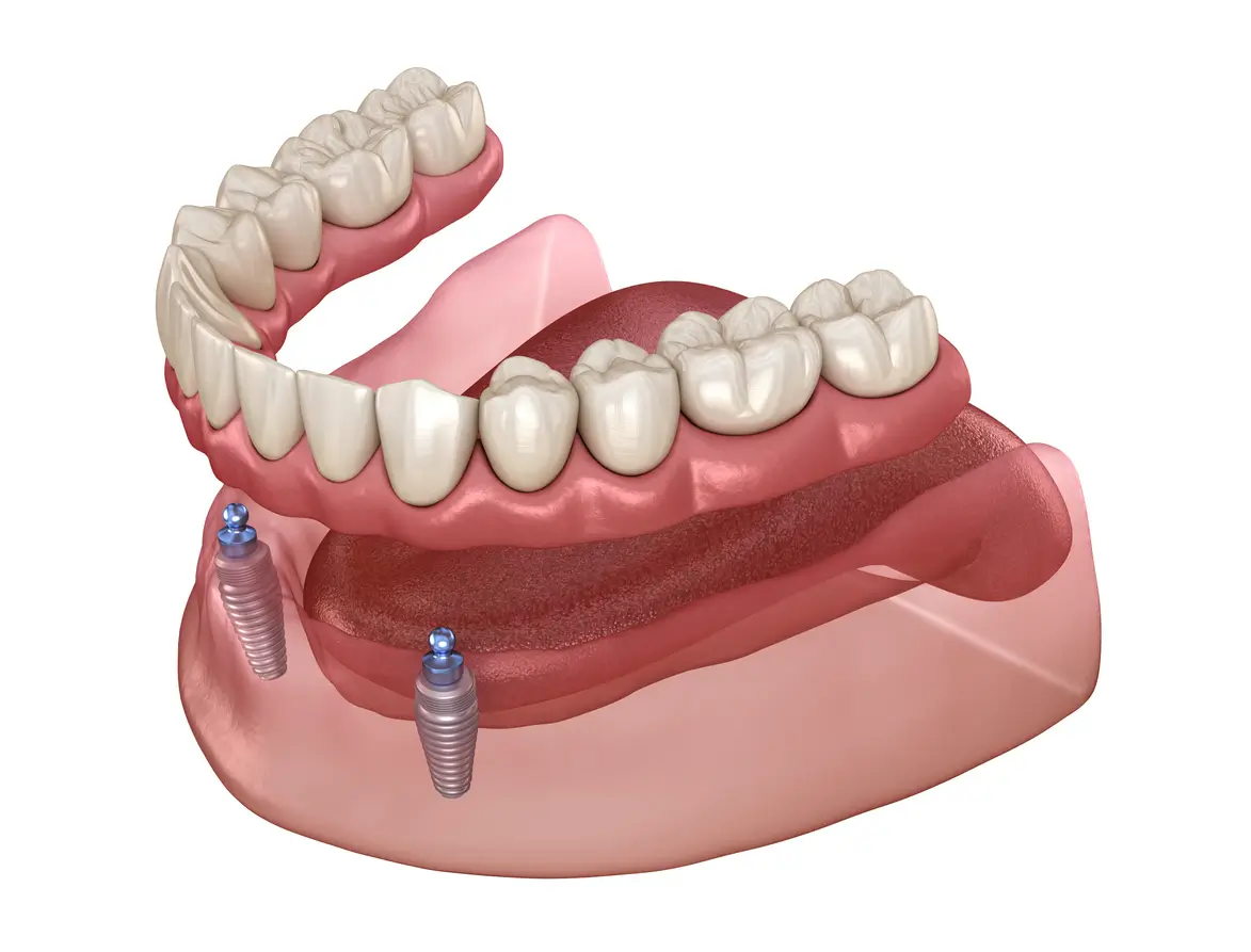 Implant-Supported Dentures illustration 1 — Duneside Dental in Muskegon, Michigan