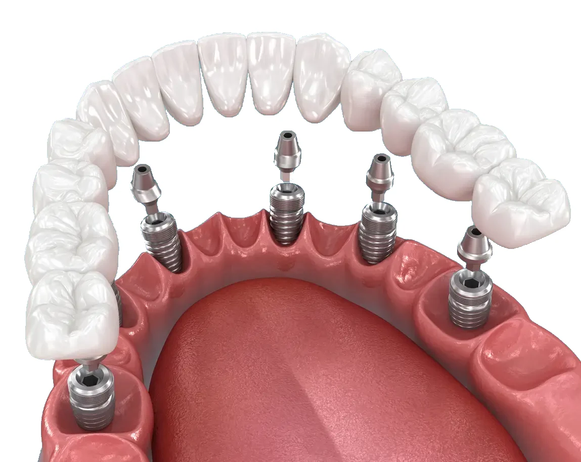 Implant-Supported Dentures illustration 2 — Duneside Dental in Muskegon, Michigan
